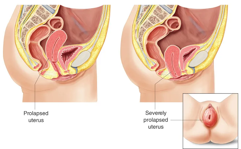 Genital Prolapse | Chapter 17 | Midwifery For Diploma In Nursing