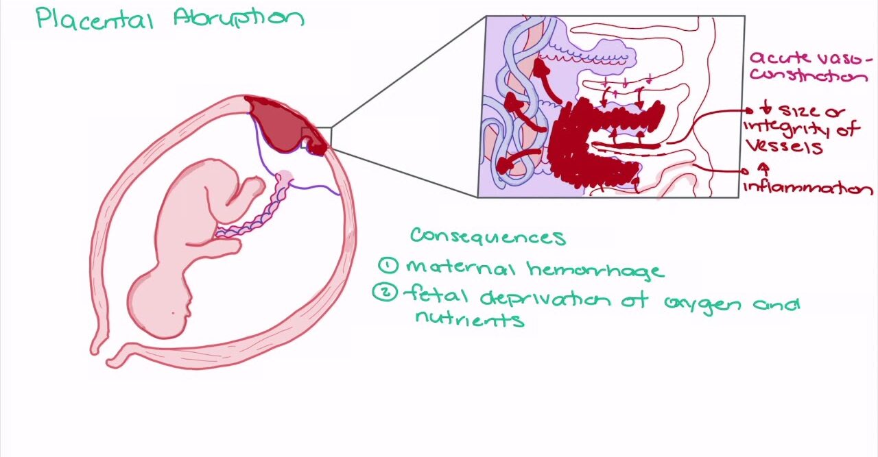 Abruptio placenta