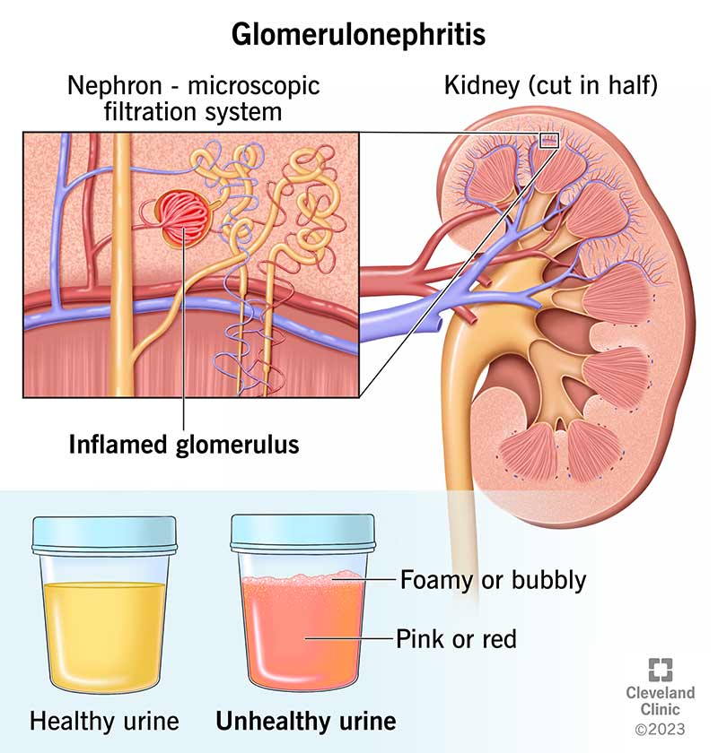 Acute glomerulonephritis | CHAPTER 12 | Pediatric Nursing