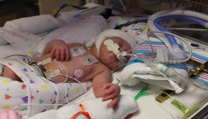 Birth asphyxia / Neonatal asphyxia