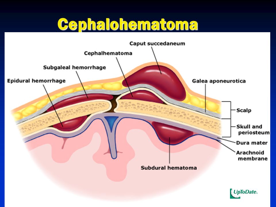 Caput succedaneum and Cephalohematoma