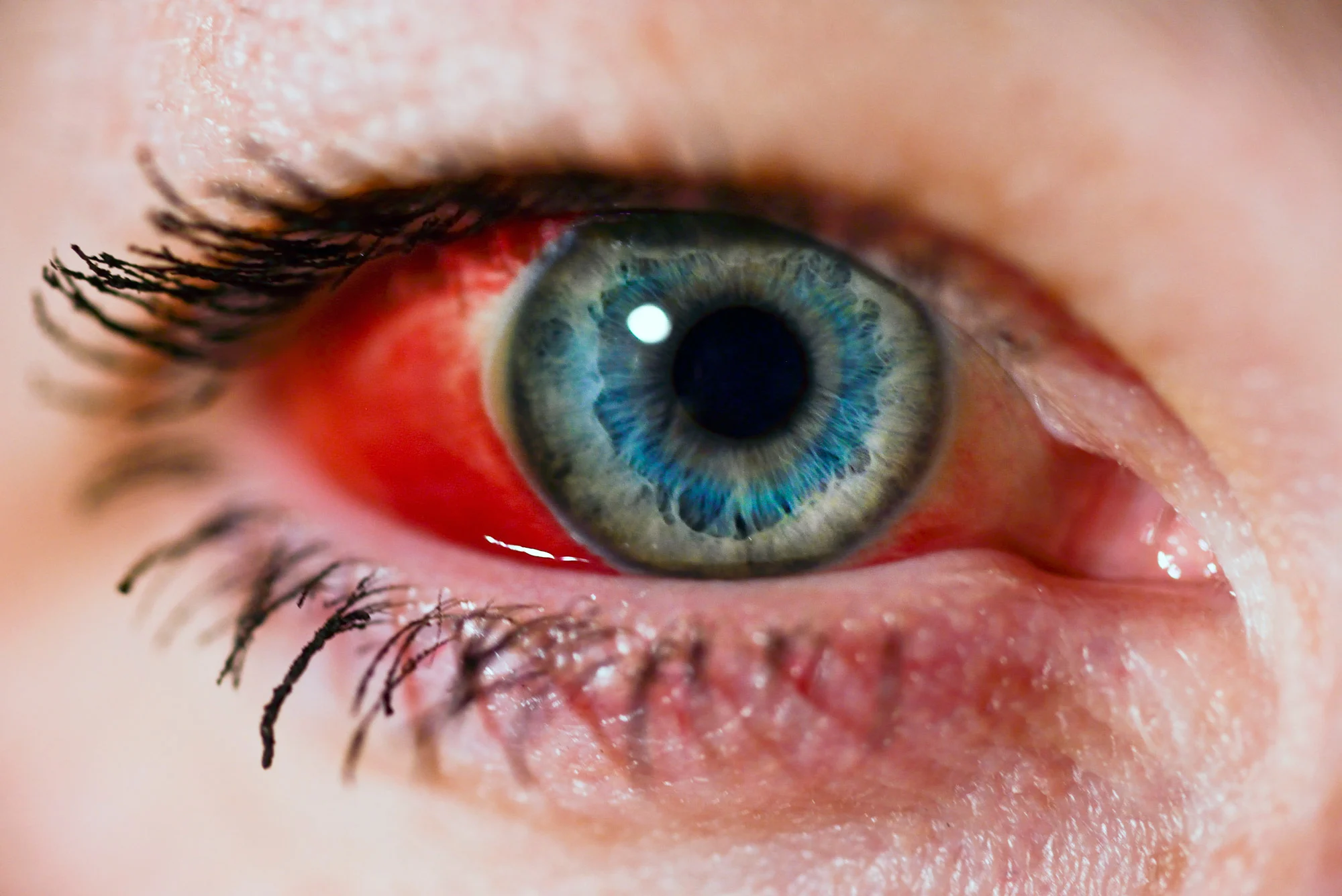 Caput succedaneum and Cephalohematoma
