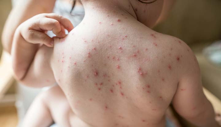 Chicken pox and small pox