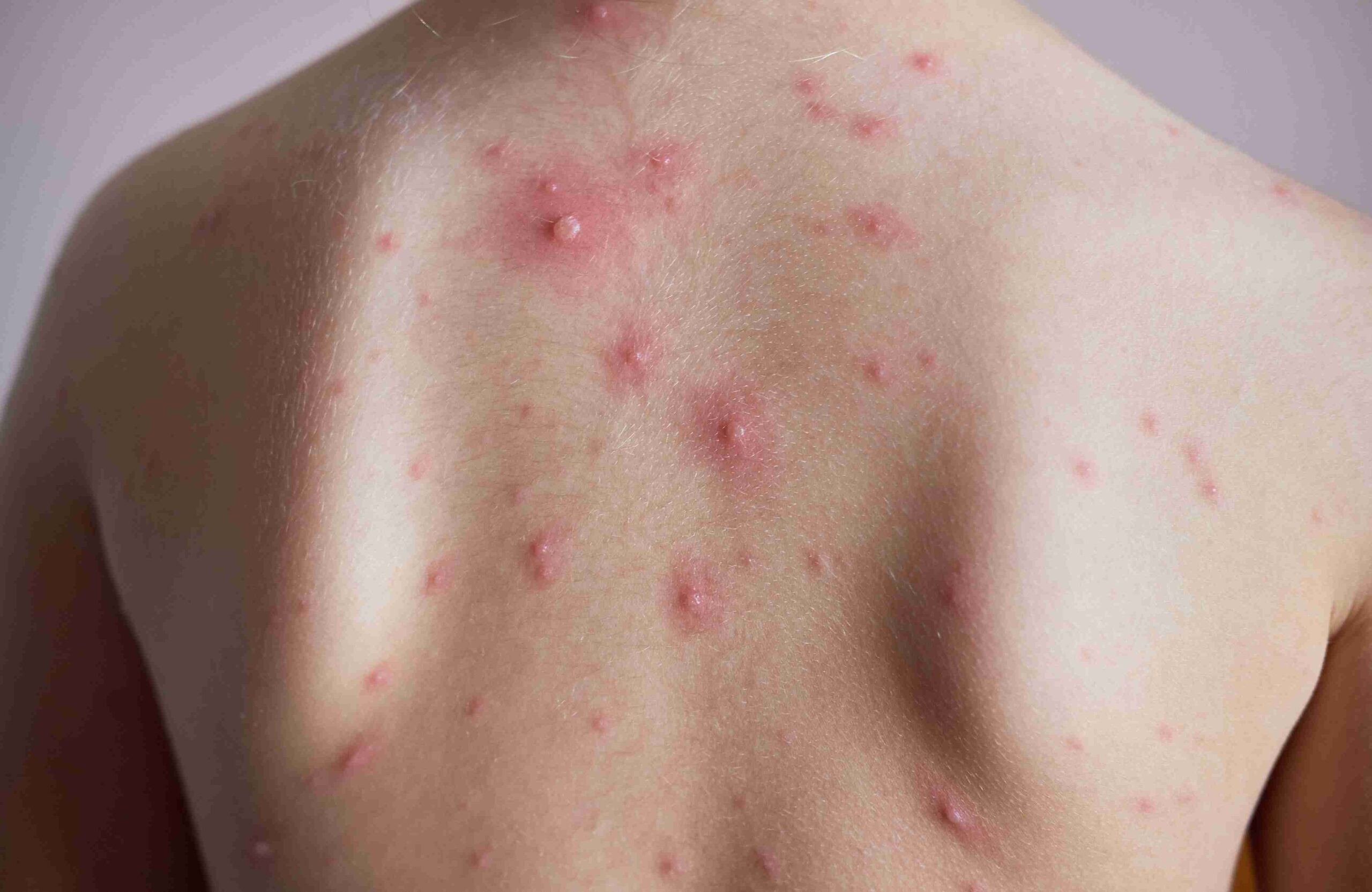 Concept about Chickenpox | CHAPTER 13 | Pediatric Nursing