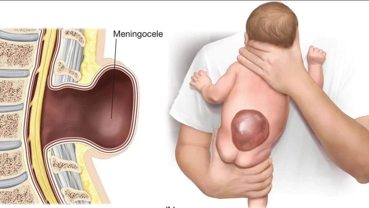 Classification of Meningocelt / myelomeningocele