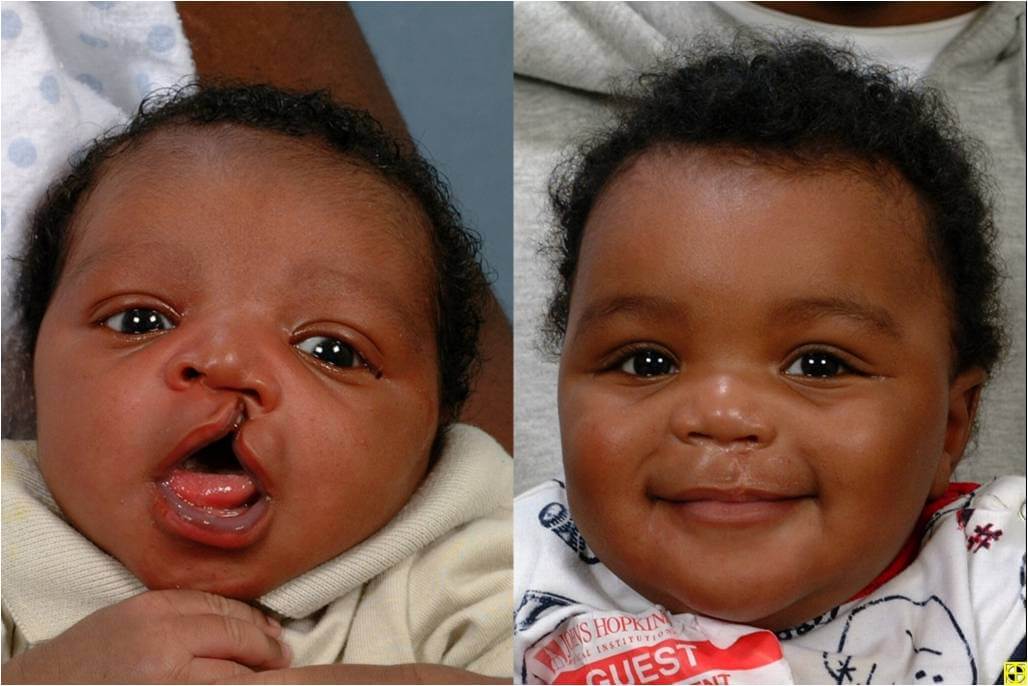 Classification of Cleft lip and cleft palate