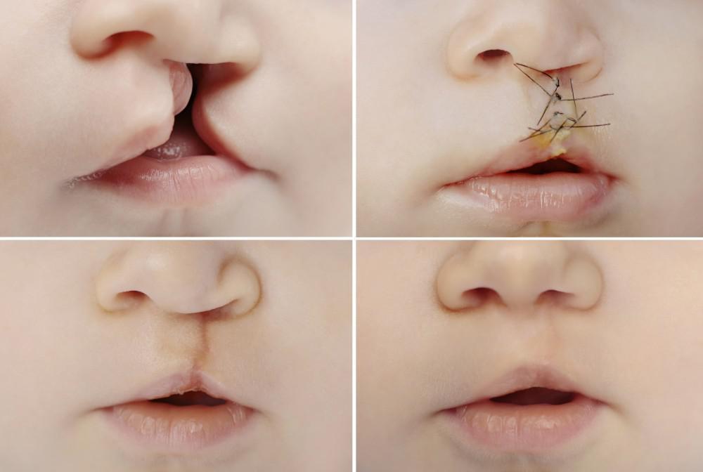Classification of Cleft lip and cleft palate