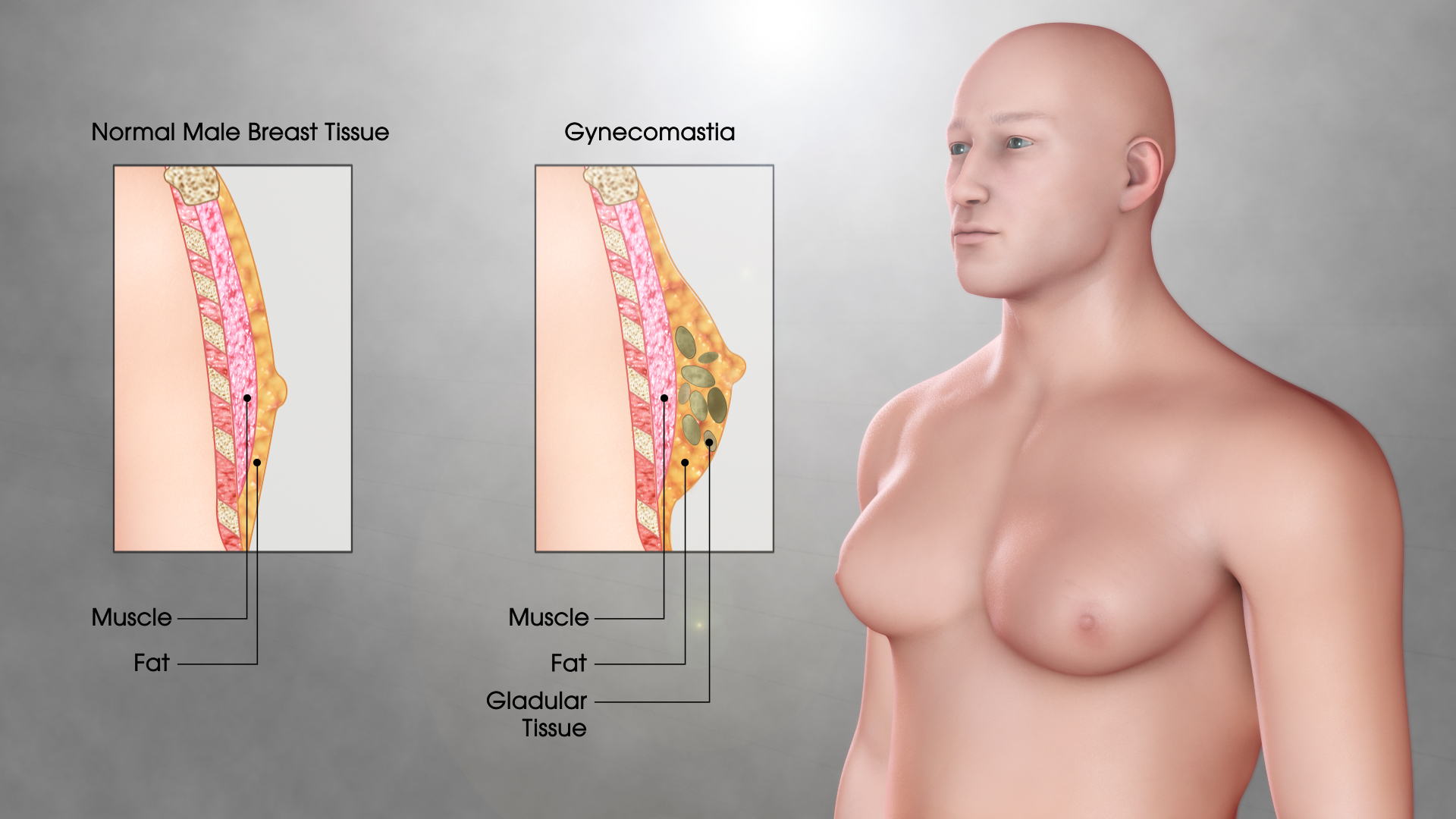Concept about Gynecomastia | CHAPTER 9 | Anatomy and Physiology