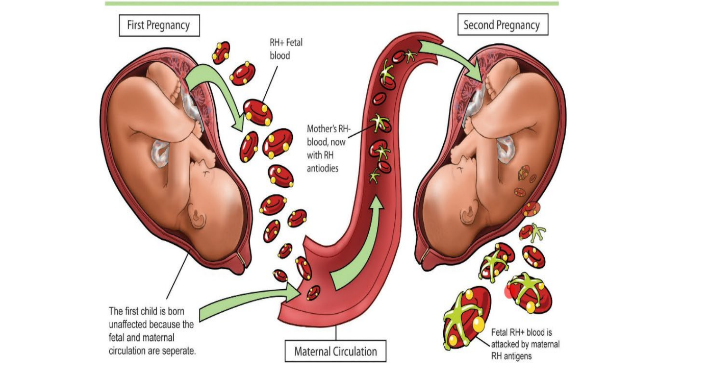 Classification of Hemolytic disease of the newborn