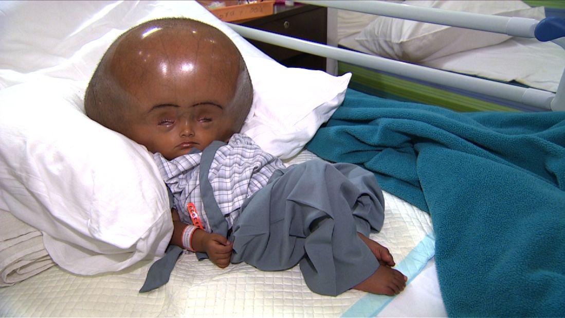 Classification of Hydrocephalus