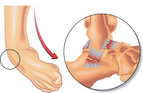 Important orthopedic terminology | CHAPTER 23 | Orthopedic Nursing