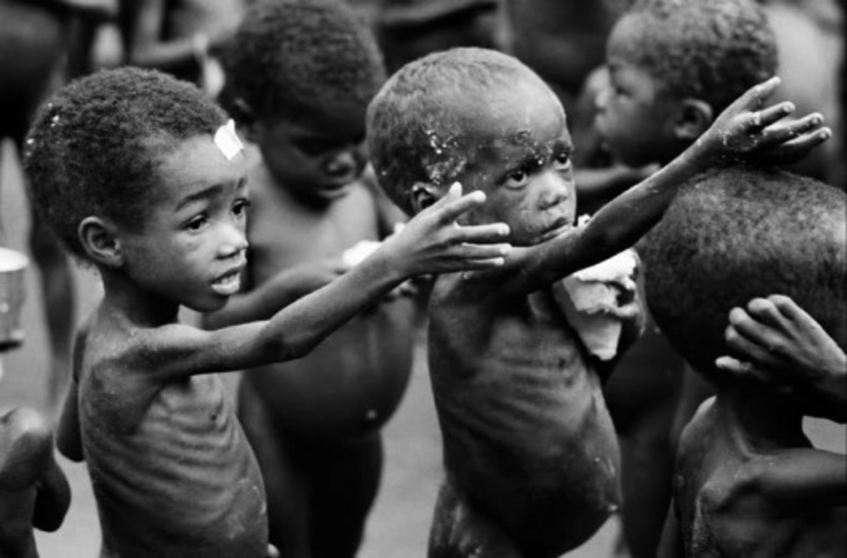Marasmus and Kwashiorkor | CHAPTER 15 | Pediatric Nursing