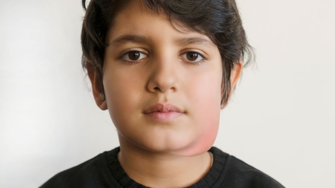 Concept about Mumps | CHAPTER 13 | Pediatric Nursing