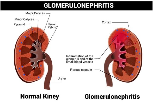 Nephritic syndrome | CHAPTER 12 | Pediatric Nursing