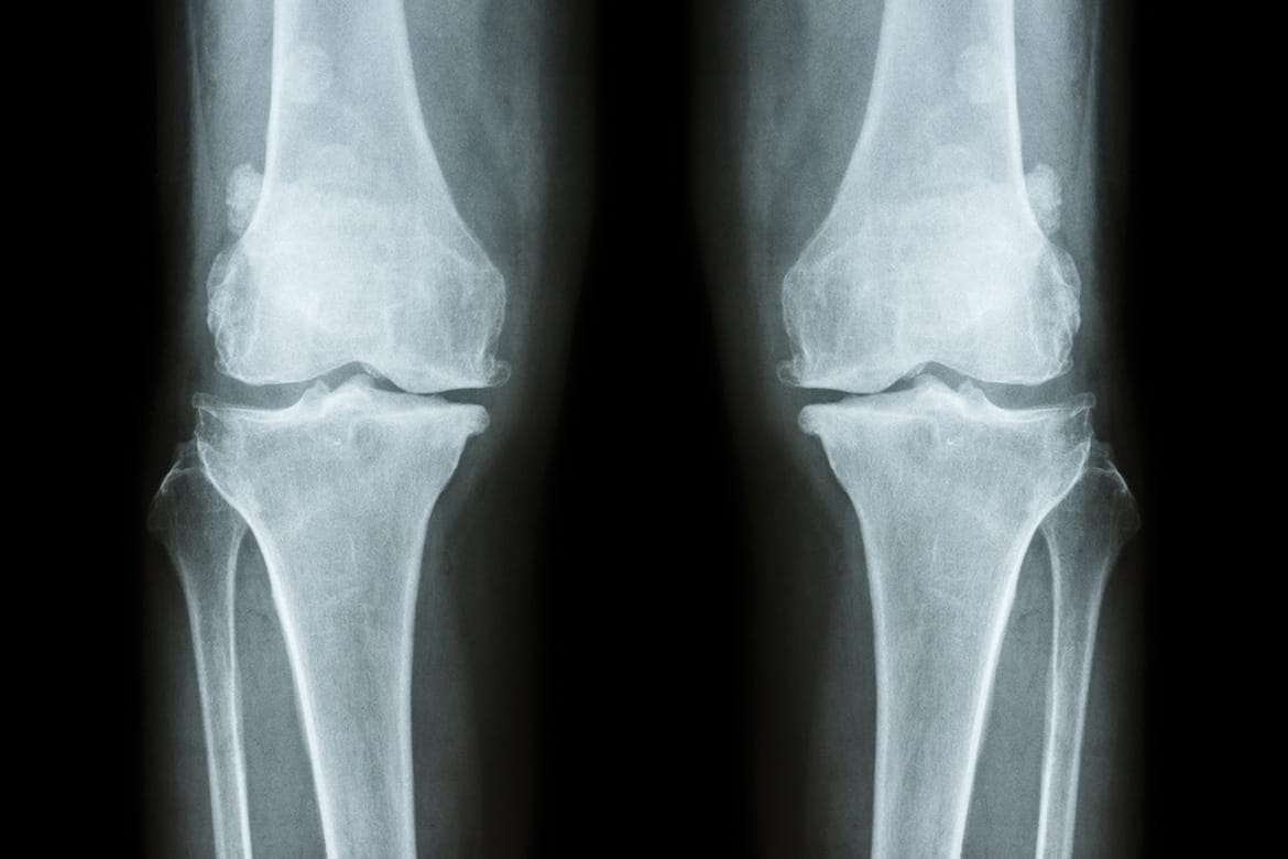 Important orthopedic terminology | CHAPTER 23 | Orthopedic Nursing