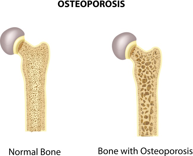 Important orthopedic terminology | CHAPTER 23 | Orthopedic Nursing