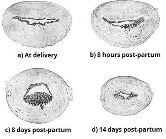 Post-Partum Hemorrhage (PPH)