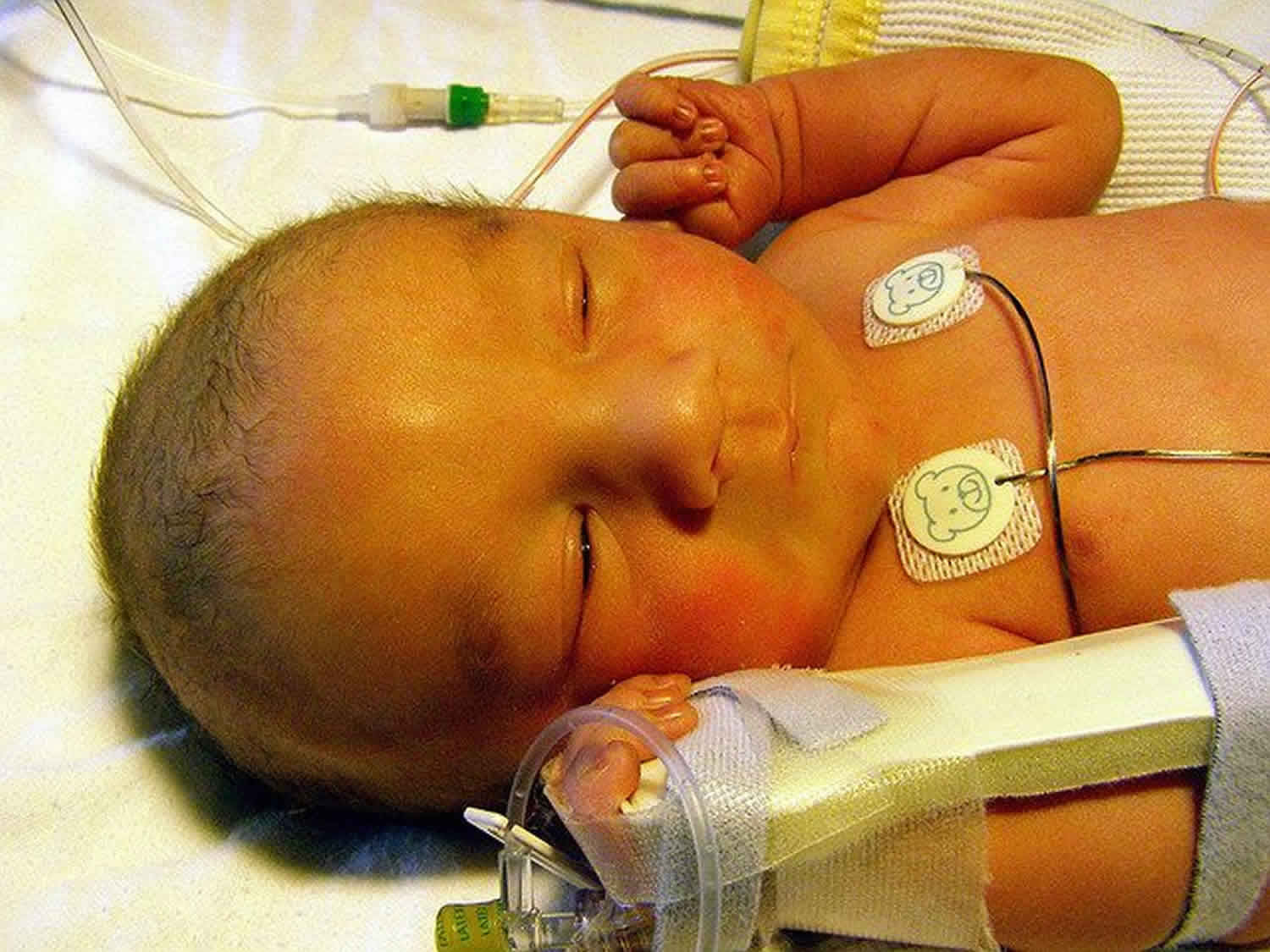 Classification of Physiological jaundice