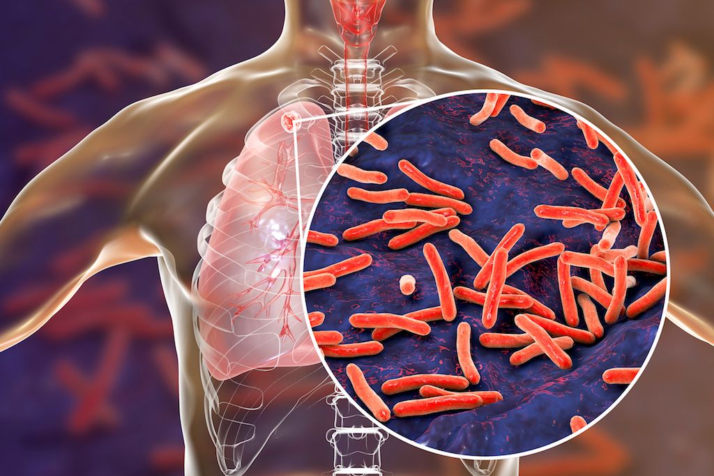 Pulmonary TB