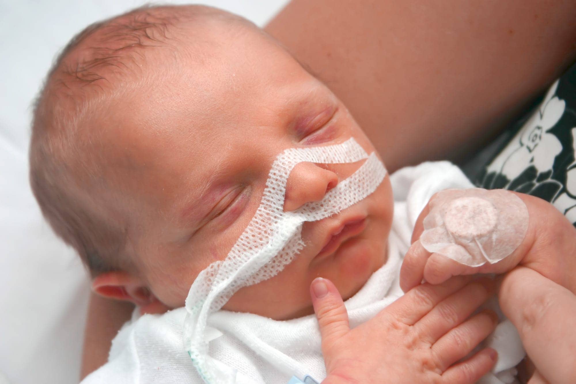 Classification of Respiratory distress syndrome (RDS)