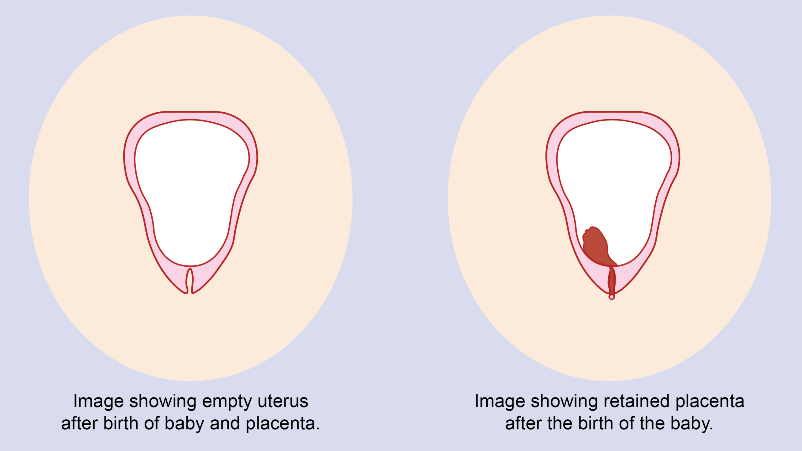 Retained Placenta