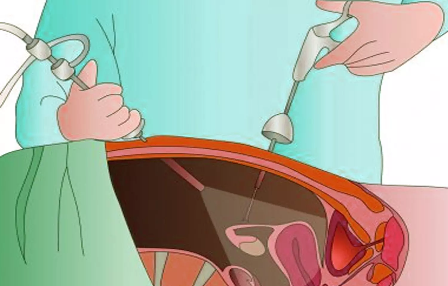 Concept about Gynecomastia | CHAPTER 9 | Anatomy and Physiology
