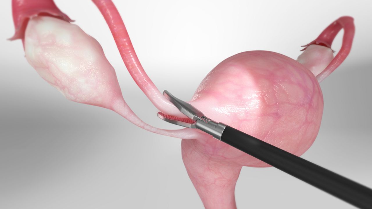 Concept about Tubectomy