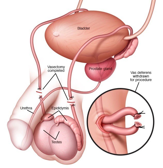 Concept about Vasectomy