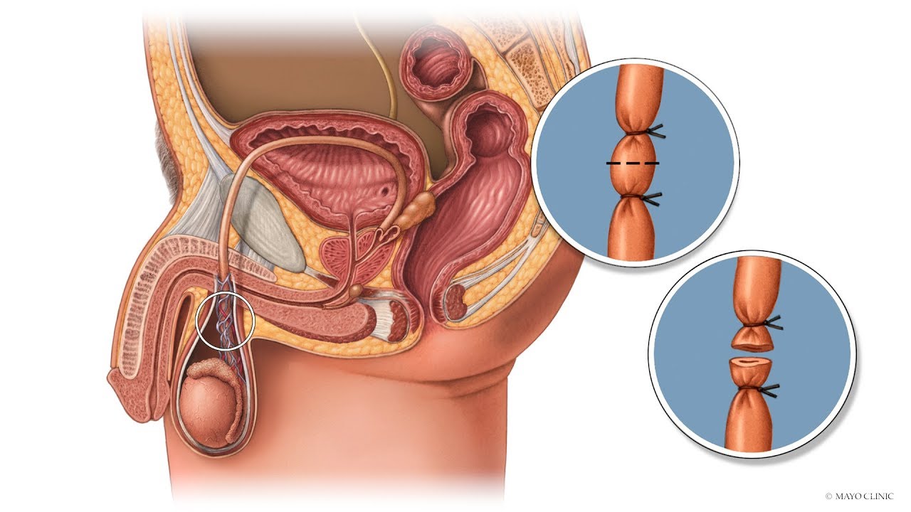 Concept about Vasectomy