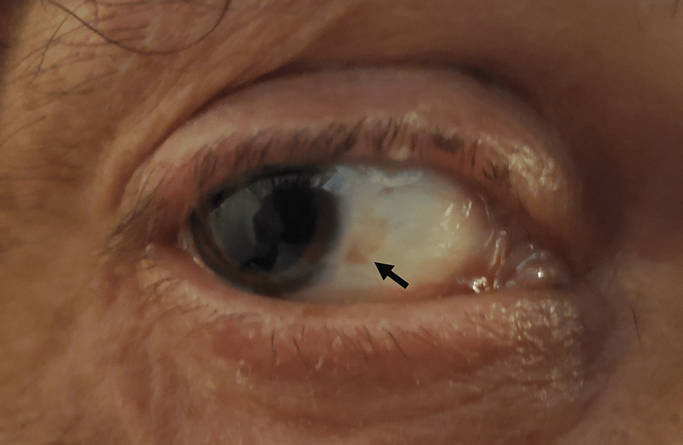 Concept about Xerophthalmia | CHAPTER 15 | Pediatric Nursing