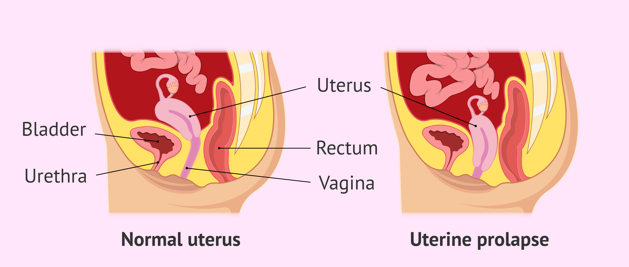 Genital Prolapse | Chapter 17 | Midwifery For Diploma In Nursing