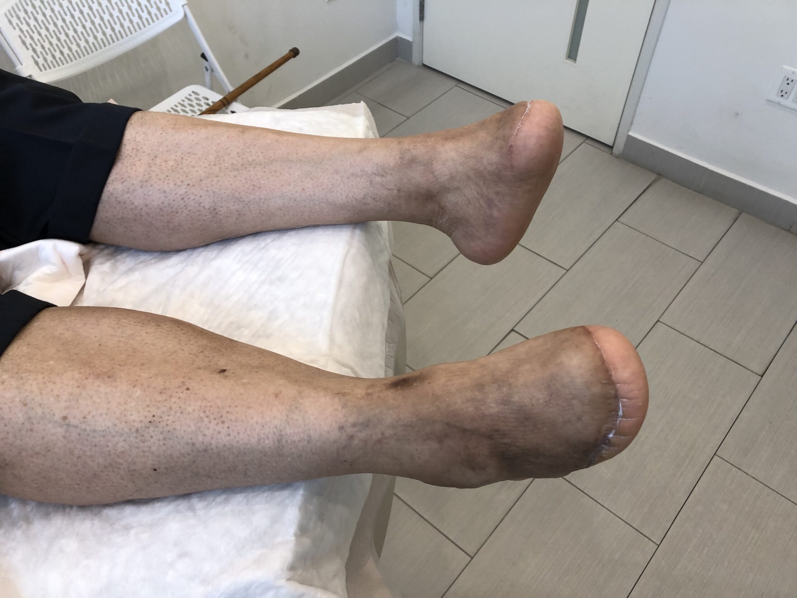 Definition of Amputation | CHAPTER 8 | Orthopedic Nursing