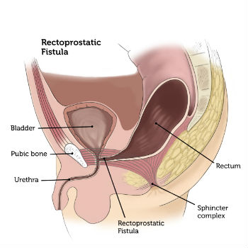 Imperforated Anus/Anorectal Malformations | CHAPTER 8 | Pediatric Nursing