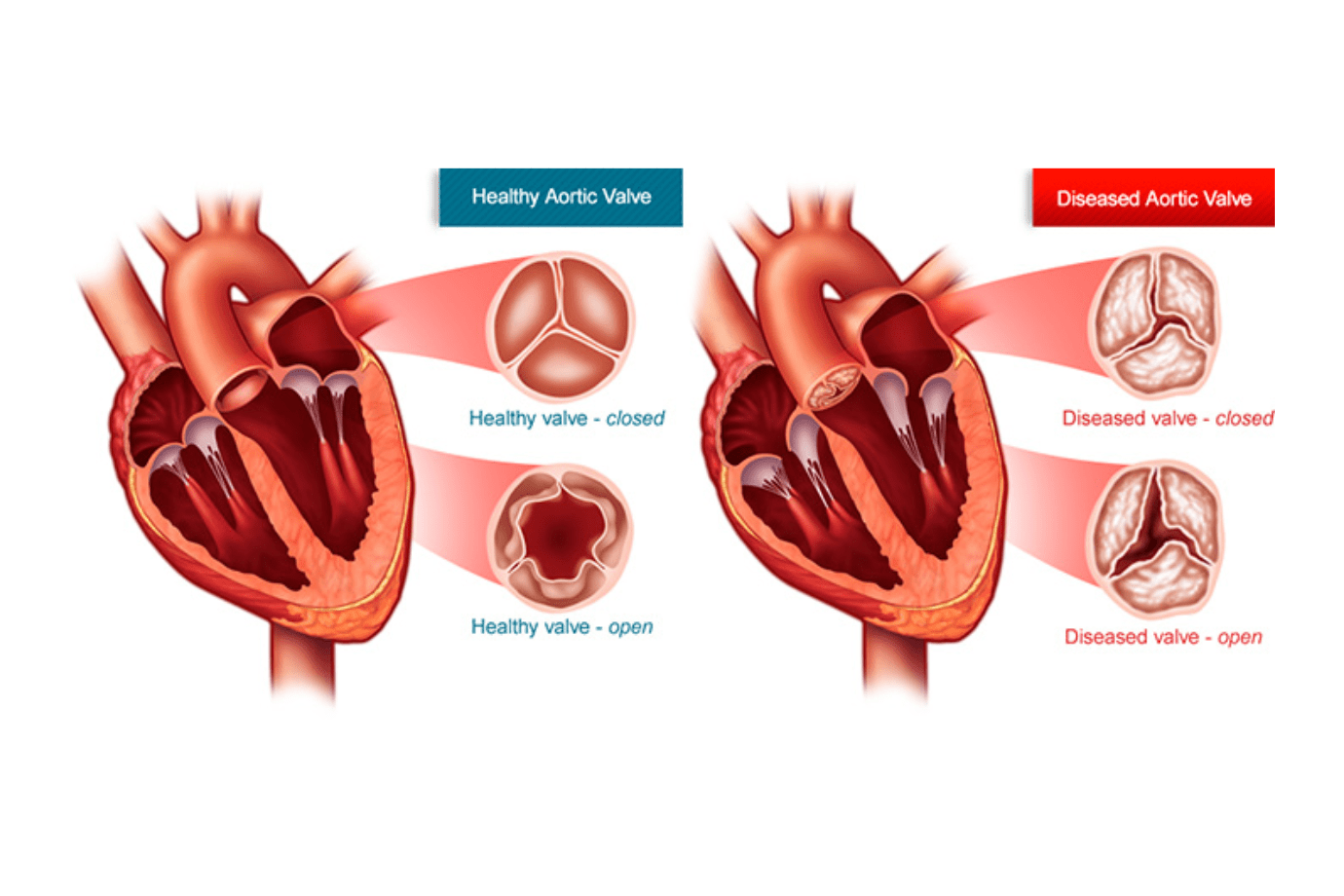 Aortic valve stenosis | CHAPTER 10 | Pediatric Nursing