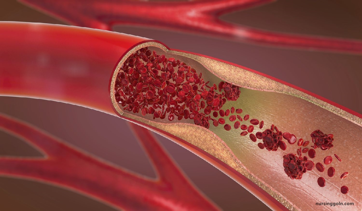 Concept of Arteriosclerosis | CHAPTER-13 | Medical and Surgical Nursing