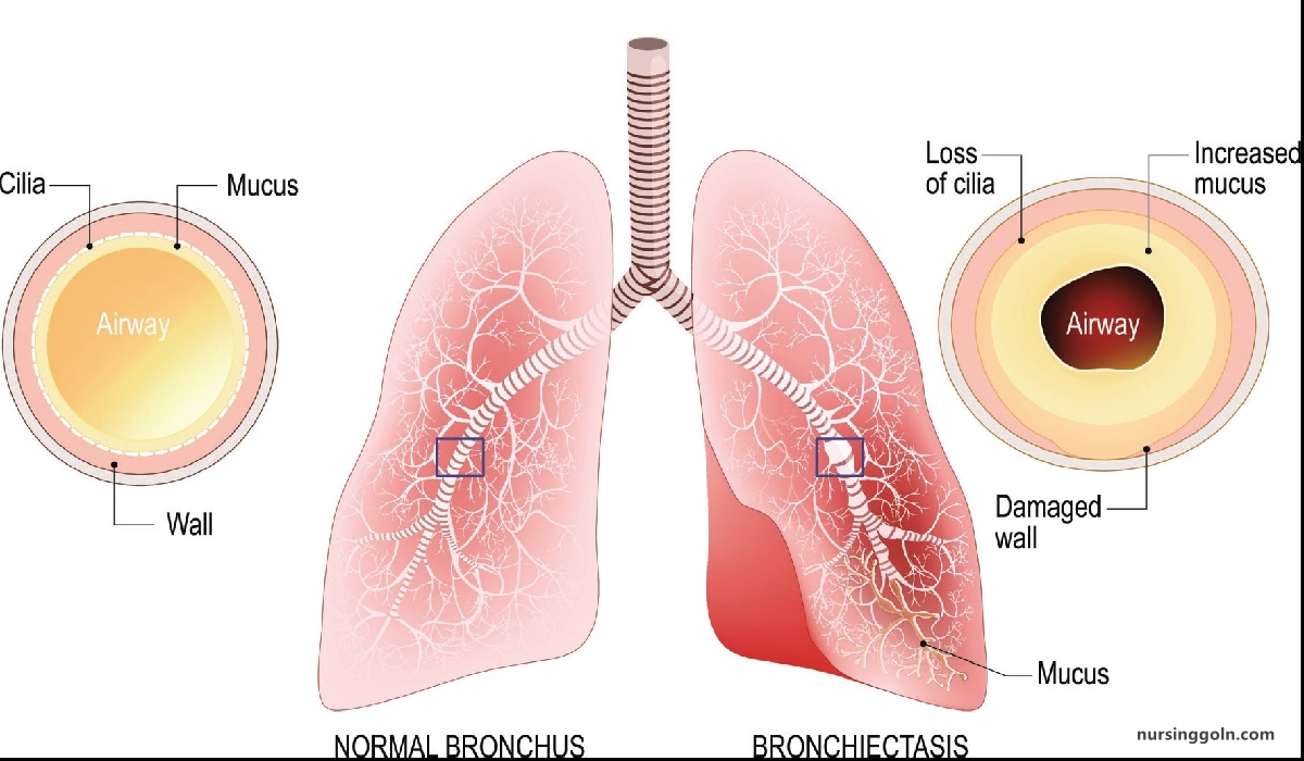 Definition of Bronchiectasis | CHAPTER-8 | Medical and Surgical Nursing