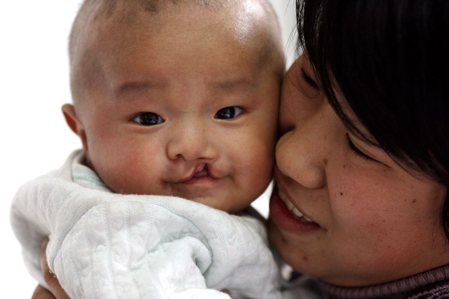 Cleft lip and cleft palate | CHAPTER 8 | Pediatric Nursing