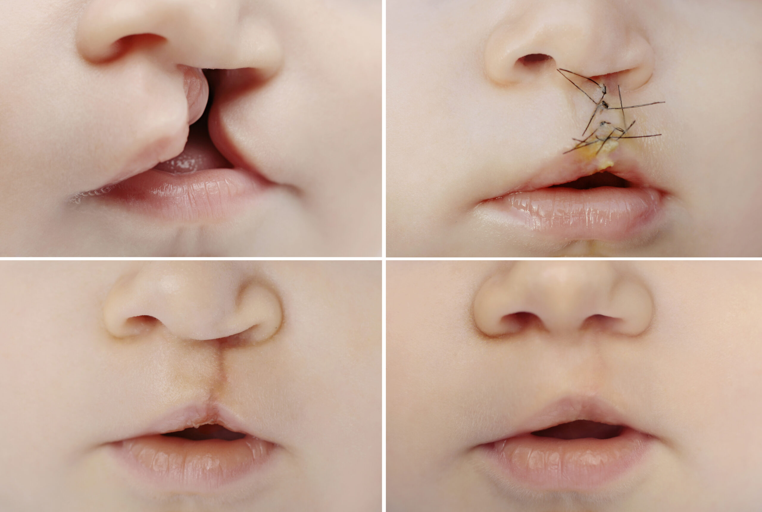 Cleft lip and cleft palate | CHAPTER 8 | Pediatric Nursing