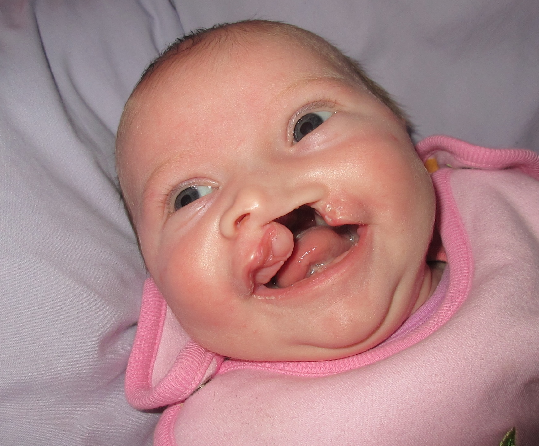 Cleft lip and cleft palate | CHAPTER 8 | Pediatric Nursing