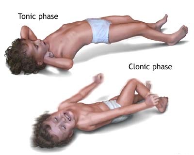 Concept about Epilepsy | CHAPTER 7 | Pediatric Nursing