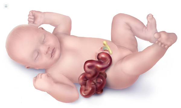 Congenital anomalies | CHAPTER 8 | Pediatric Nursing