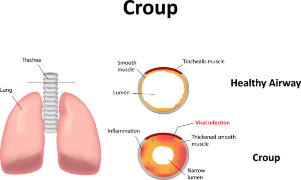Definition of Croup | CHAPTER 6 | Pediatric Nursing