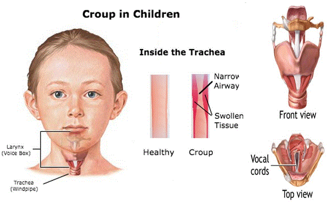 Definition of Croup | CHAPTER 6 | Pediatric Nursing