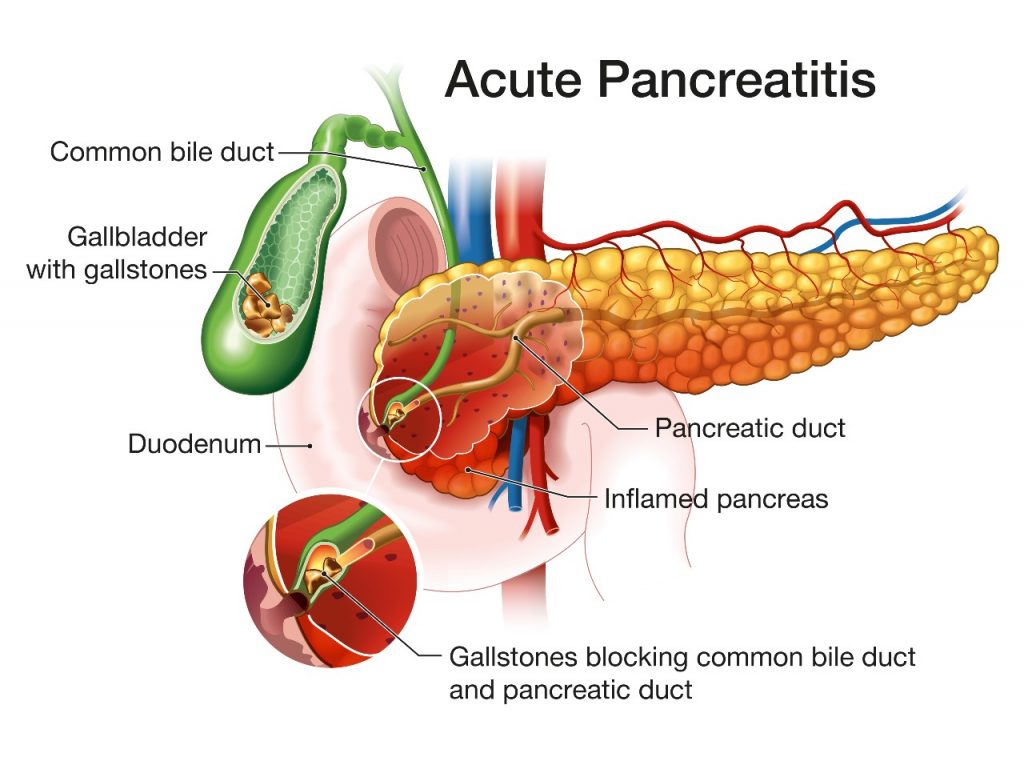 Definition of Pancreatitis | CHAPTER-6 | Medical and Surgical Nursing