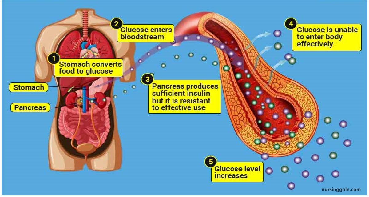 Diabetes Mellitus