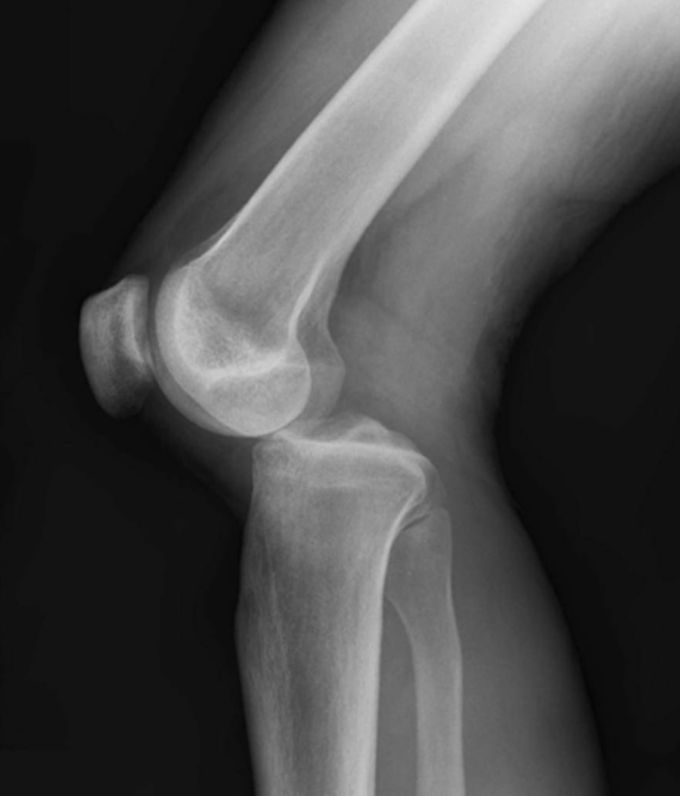 Definition of Dislocation | CHAPTER 6 | Orthopedic Nursing