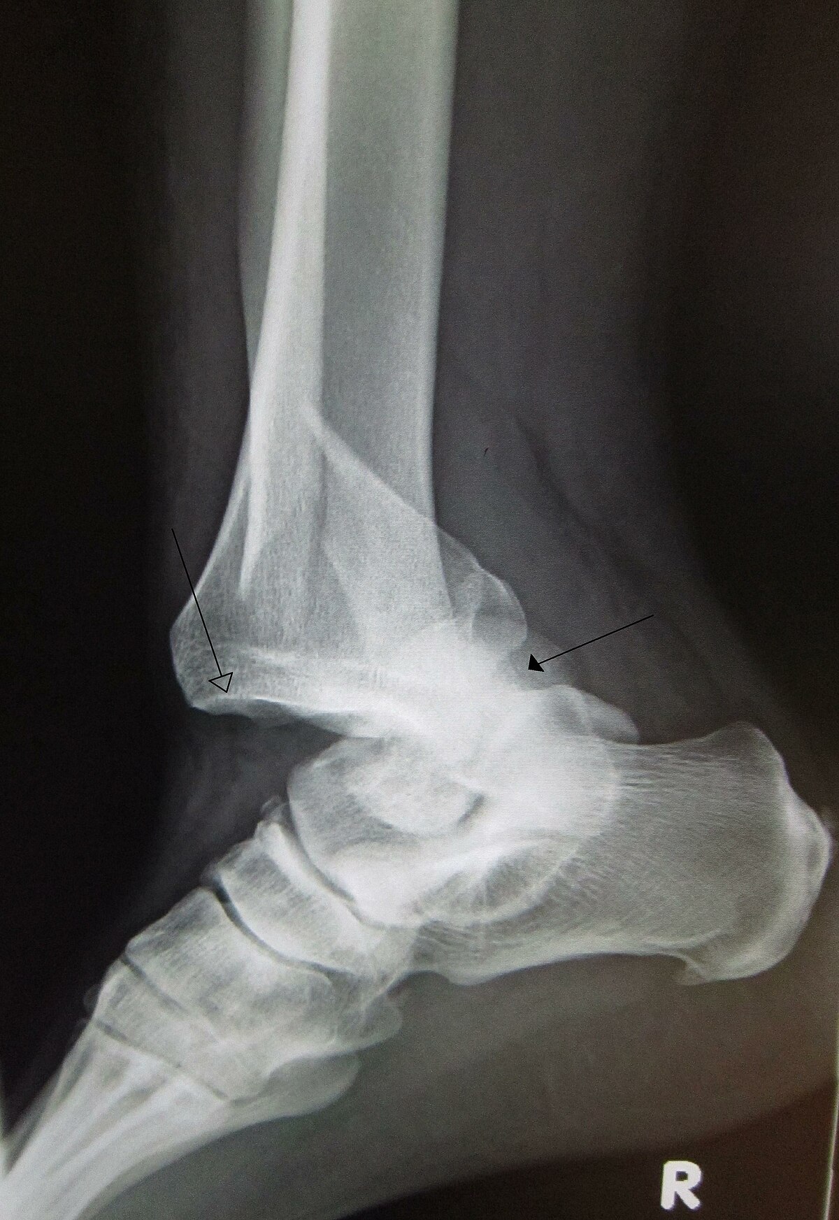 Medical Definition of Dislocation
