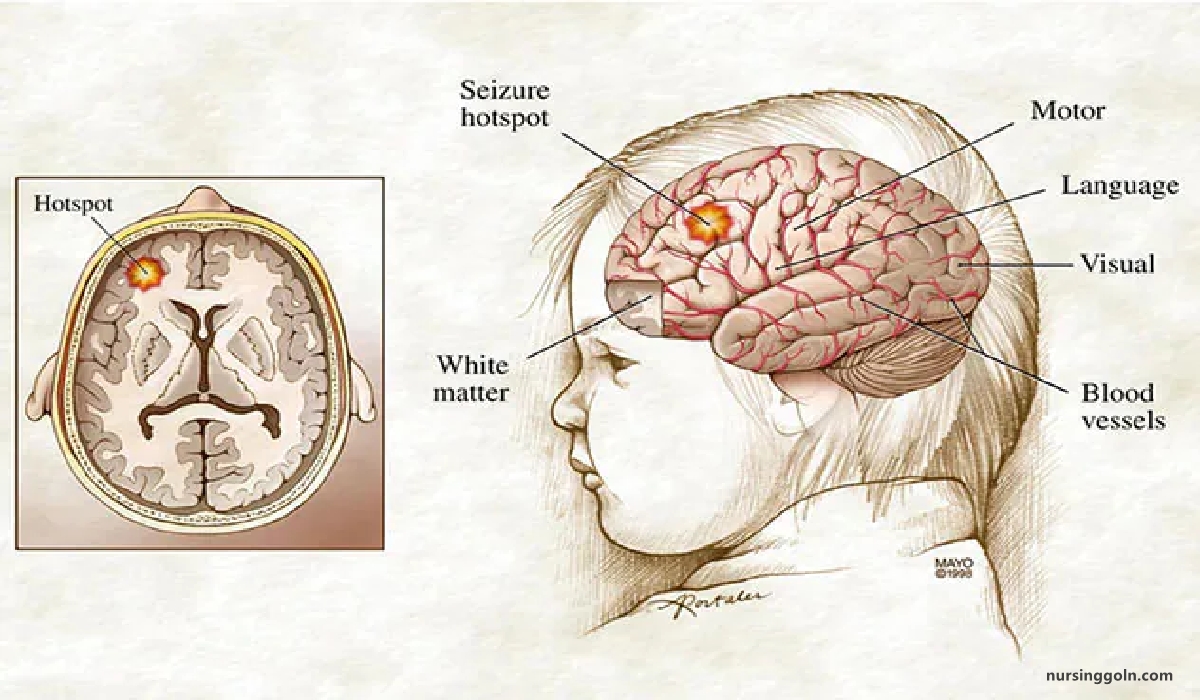 Epilepsy