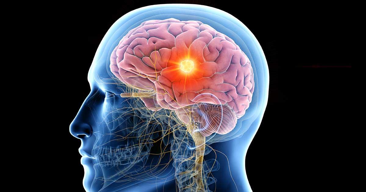 Concept about Epilepsy | CHAPTER 7 | Pediatric Nursing