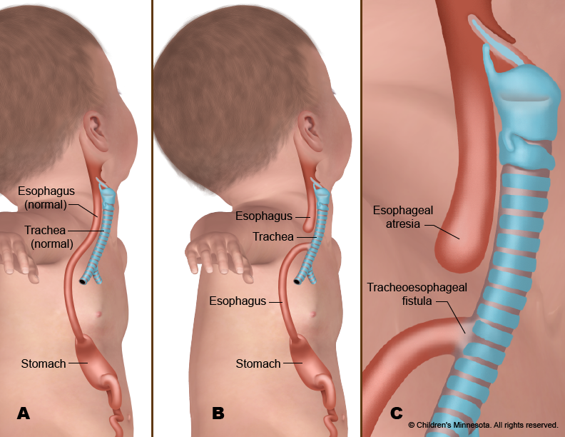 Esophageal Atresia/Trachea-Eosophageal Fistula | CHAPTER 8 | Pediatric Nursing